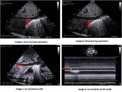 Echocardiographic Evaluation of Hemodynamics in Neonates and Children